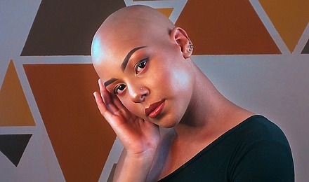 Alopecia Universalis Featured Image