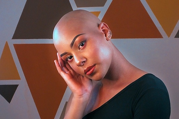 Alopecia Universalis Featured Image