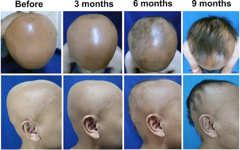 alopecia universalis patient before and after combined treatment