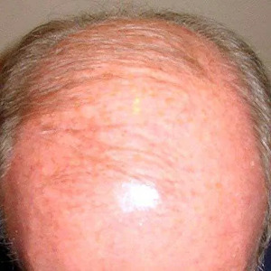 Example of androgenetic alopeca