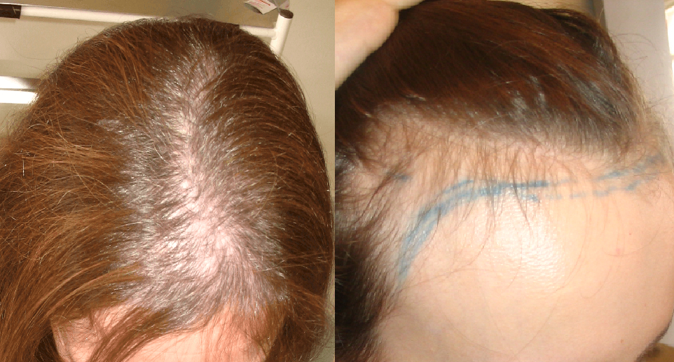 Androgenetic Alopecia: Causes, Diagnosis &#038; Treatment, Wimpole Clinic