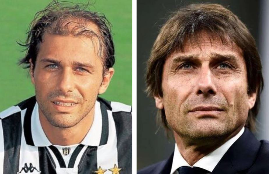 Antonio Conte before and after hair transplant