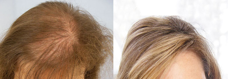 before and after results of an artificial hair transplant