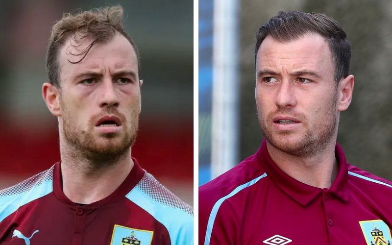 Ashley Barnes before and after hair transplant