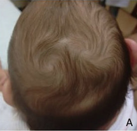 Double Crown Vs Balding: Differences, Symptoms, Treatments