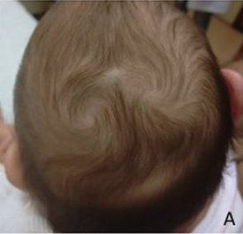 The swirl a double crown makes in a baby's hair