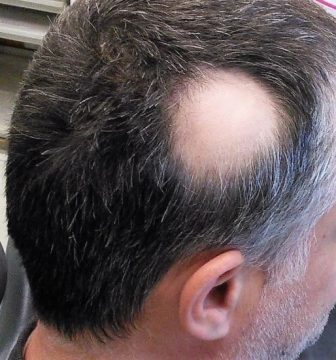 bald spot due to alopecia areata