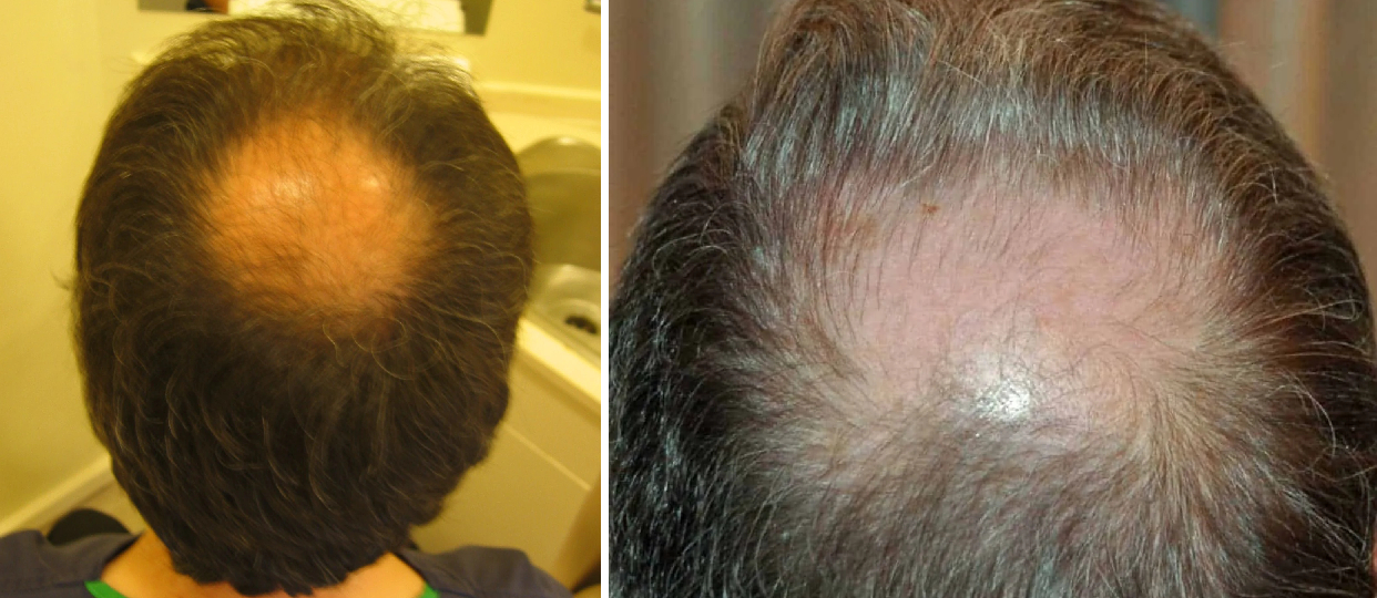 The Best Hair Loss Treatments for Men and Women - GoodRx
