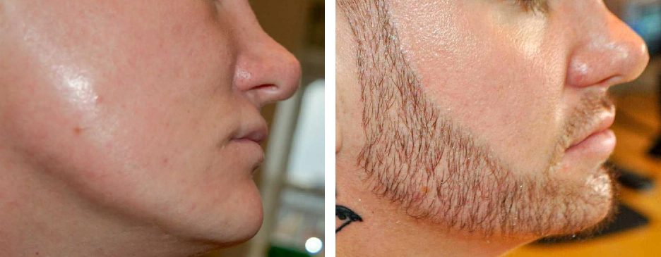 beard hair growth results 18 months after transplant