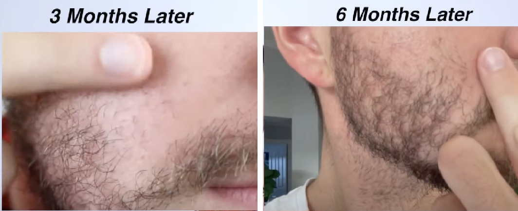 beard rolling results after 3 and 6 months