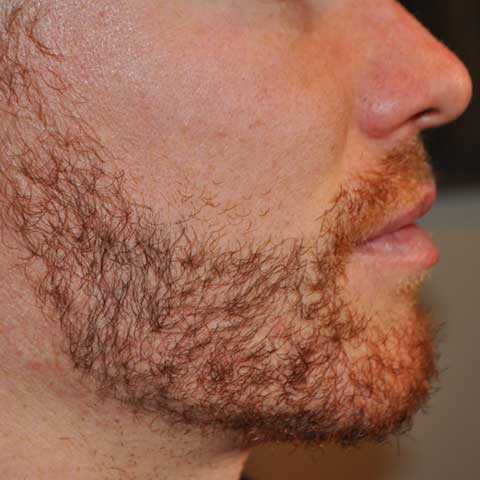 Beard Transplant, Wimpole Clinic