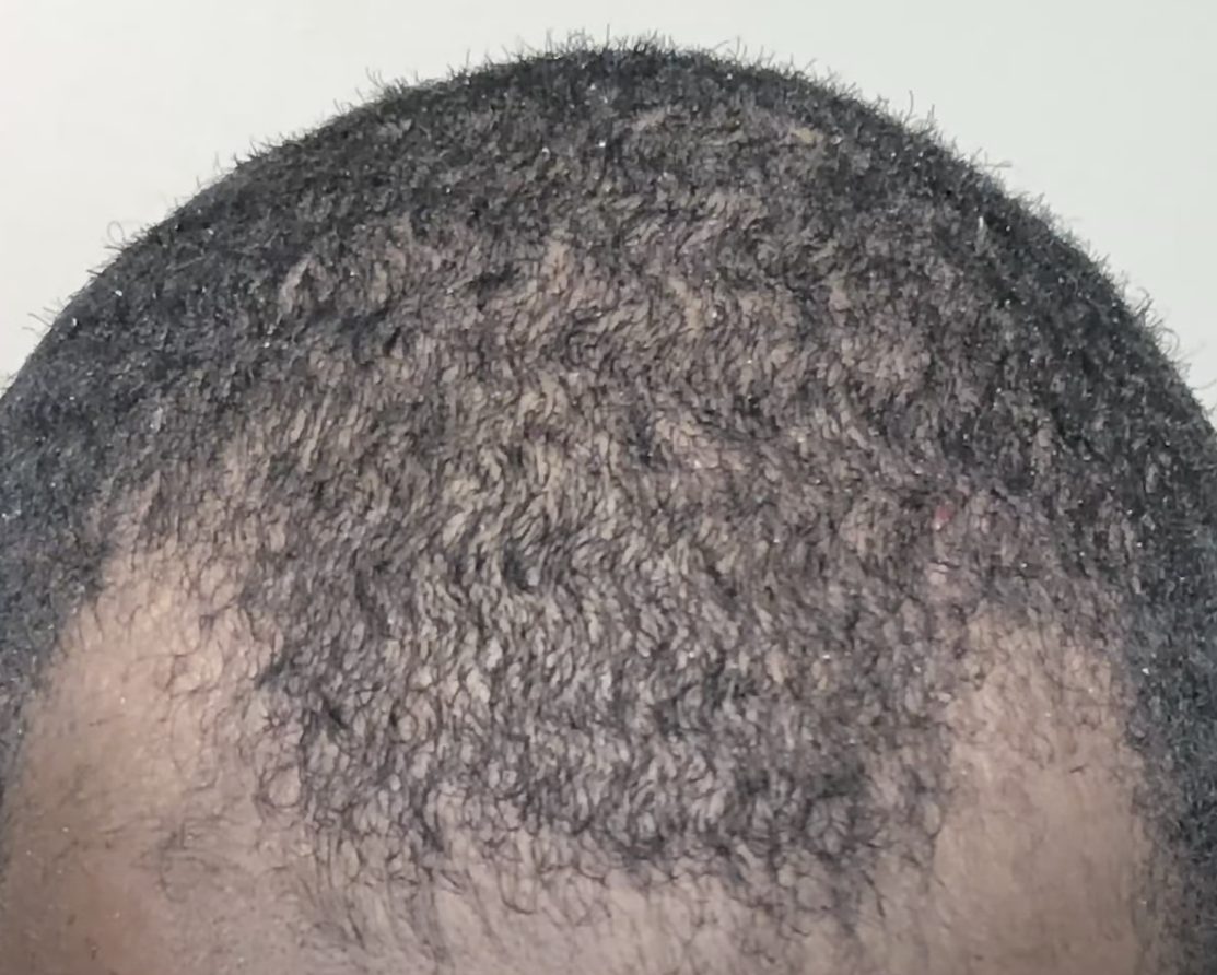 before afro hair transplant
