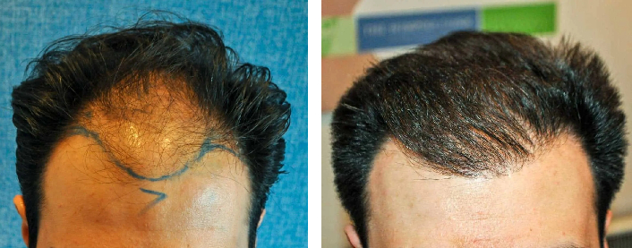 before after 2000 graft hair transplant for a receding hairline