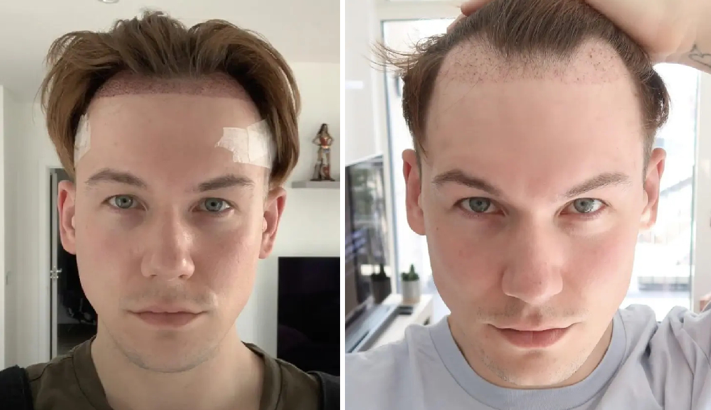 before and 1 month after FUE hair transplant