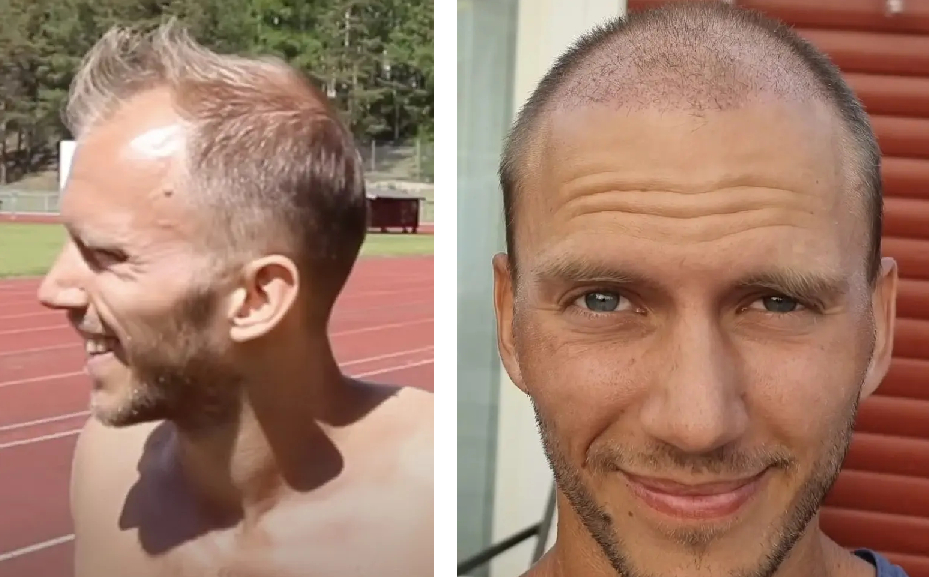 before and 1 month after FUE hair transplant