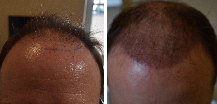 before and 1 month after hair transplant