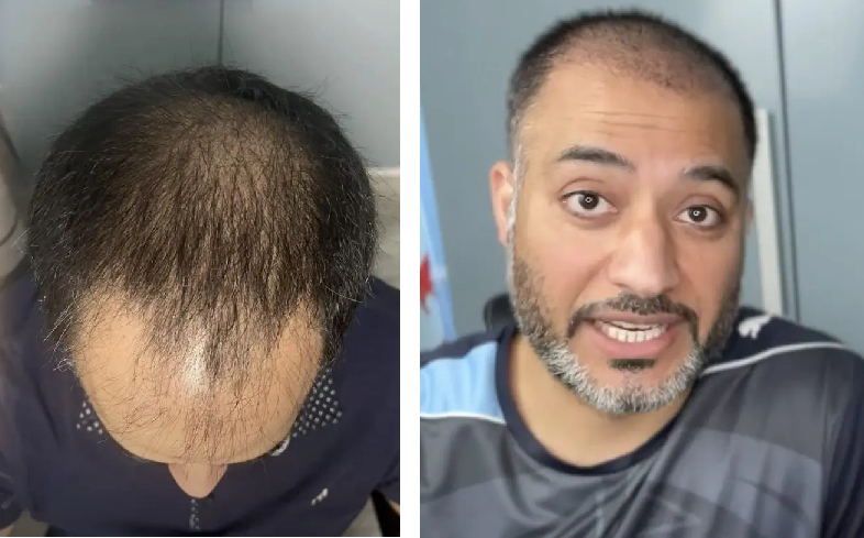 before and 1 month after hair transplant