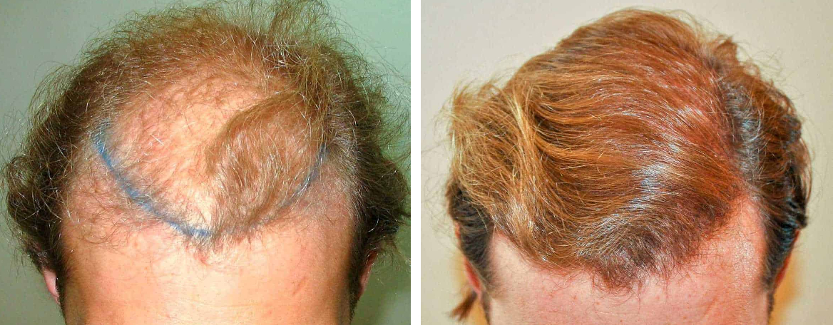 Before hair transplant and 18 months after