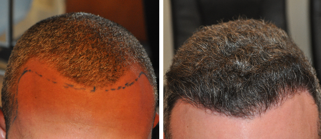 before and 10 months after a 1000 grafts hair transplant
