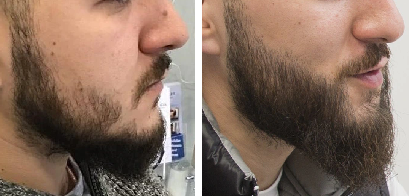 before and 10 months after beard transplant