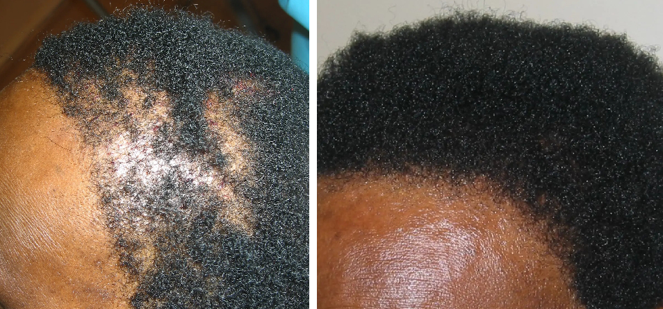 before and 10 months after hair transplant