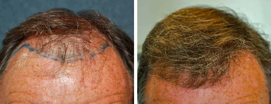 before and 12 months after FUE hairline transplant