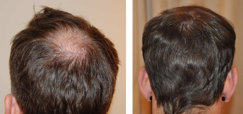 before and hair growth results 12 months after crown hair transplant