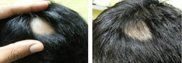 before and 12 weeks after Minoxidil use for alopecia areata