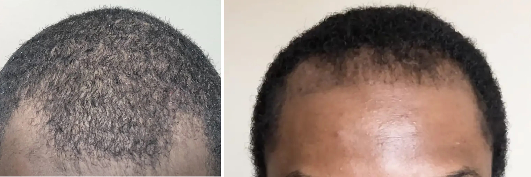 before and 2 months after afro hair transplant