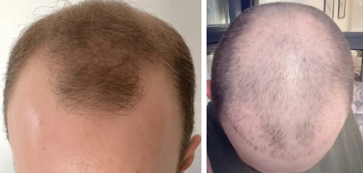 Hair Transplant After 2 Months: Photos, Results, Side Effects, Wimpole Clinic