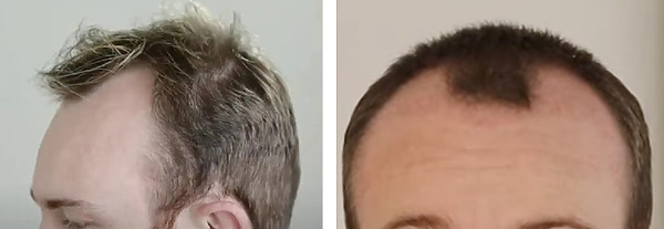 Hair Transplant After 2 Months: Photos, Results, Side Effects