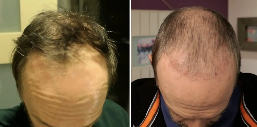 before and 2 months after hair transplant