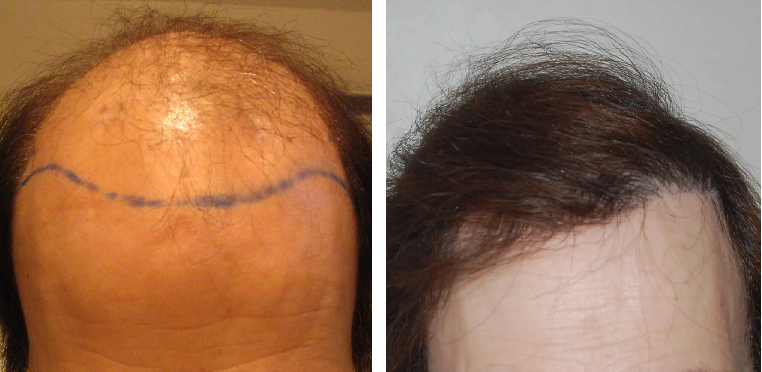 bald scalp due to male pattern baldness before and 30 months after transplant