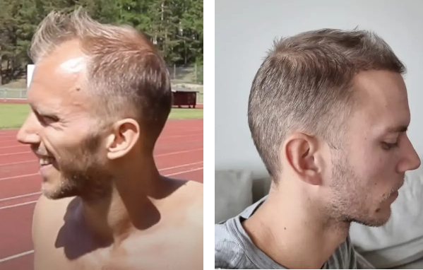 before and 4 months after hair restoration surgery