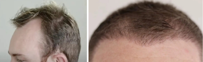 Hair Transplant After 4 Months Photos Results Side Effects 9690