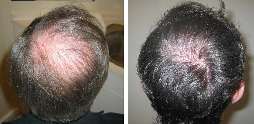 How Much Does A Crown Hair Transplant Cost?