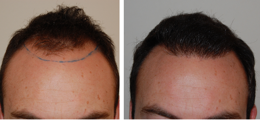 Hair growth before and 6 month after hair transplant surgery
