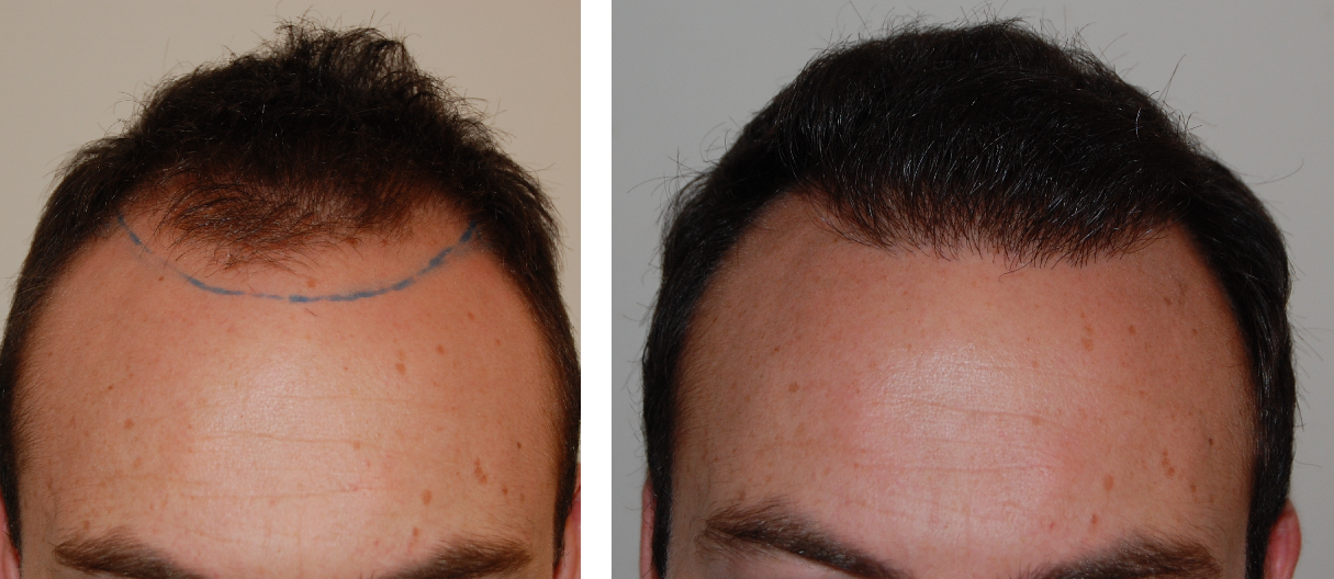 before and 6 months after hair transplant
