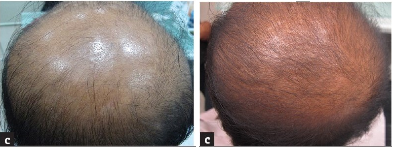 before and 6 months after micro-needling in a 28 year old patient