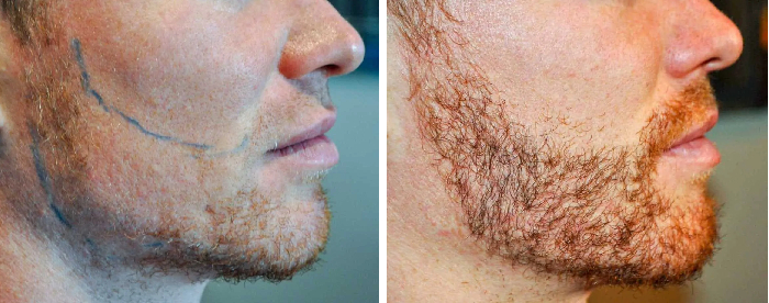 before and 8 months after beard transplant