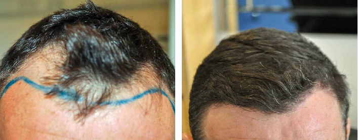 before and 8 months after hair transplant