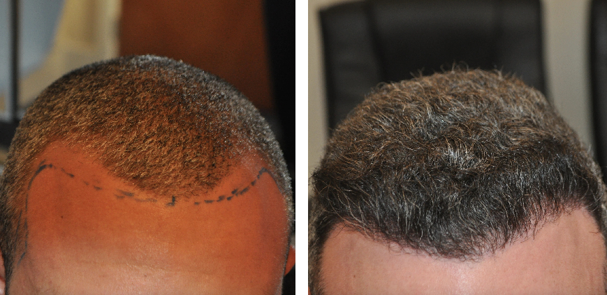 before and after 1000 graft FUE hair transplant to correct Norwood 2 hair loss