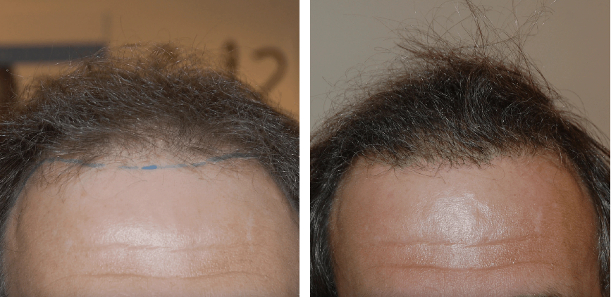 before and after 1000 graft FUE hair transplant