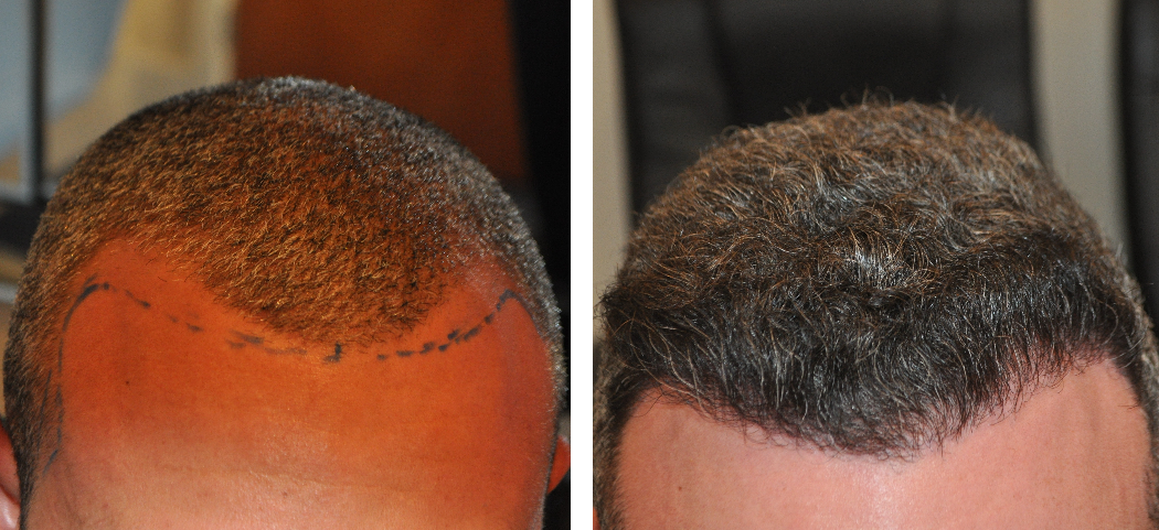 before and after 1000 graft hair transplant surgery