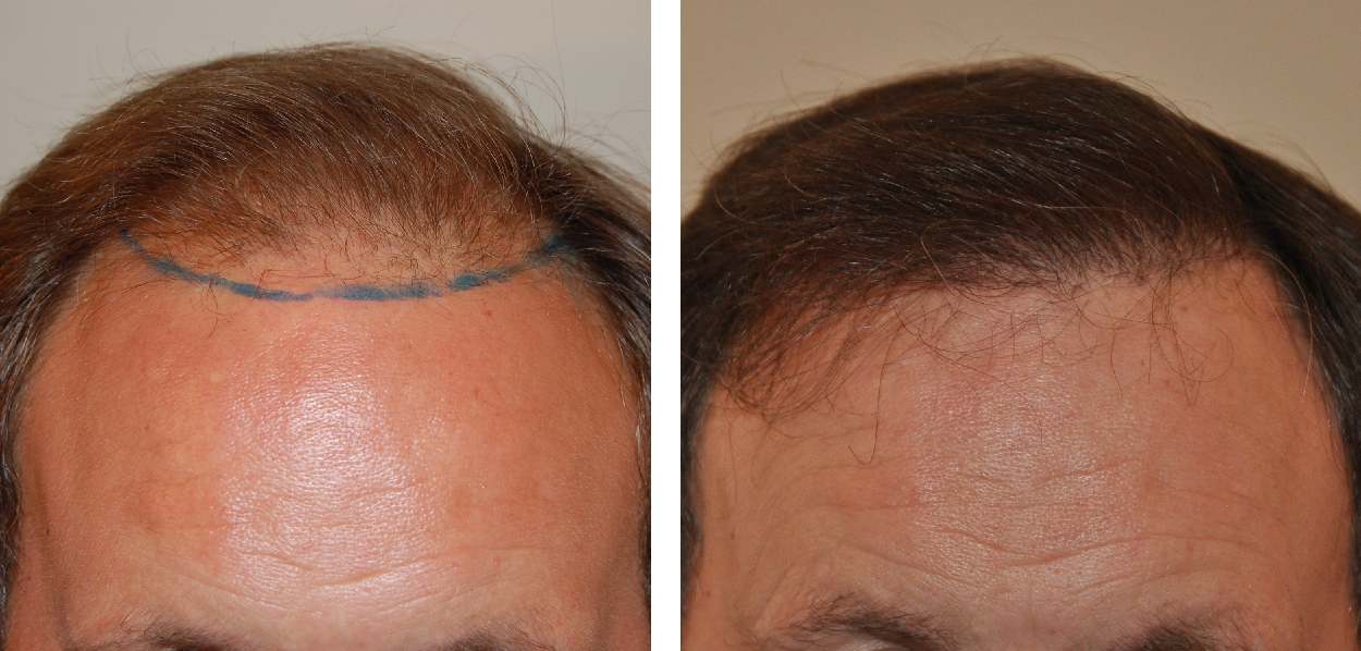 Norwood Stage 3: Photos, Treatments, Results, Wimpole Clinic