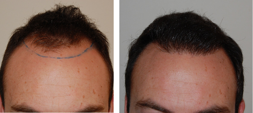 1000 Grafts Hair Transplant: Coverage, Costs, Results