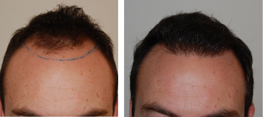 before and after 1000 graft hair transplant to bring the hairline forward