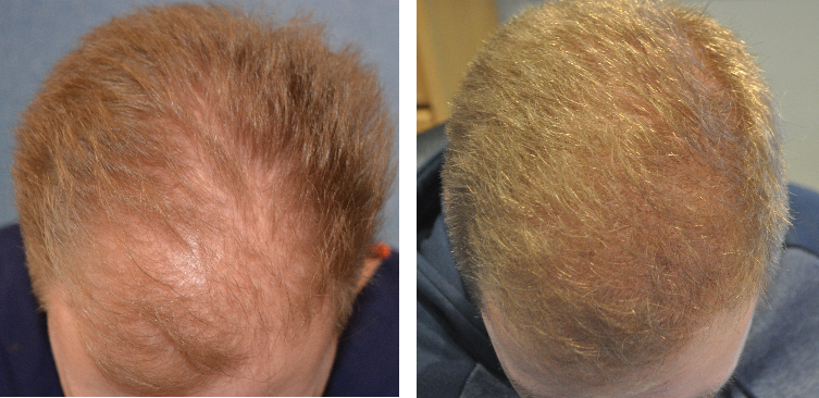 before and after 1000 grafts hair transplant to reduce hair thinning