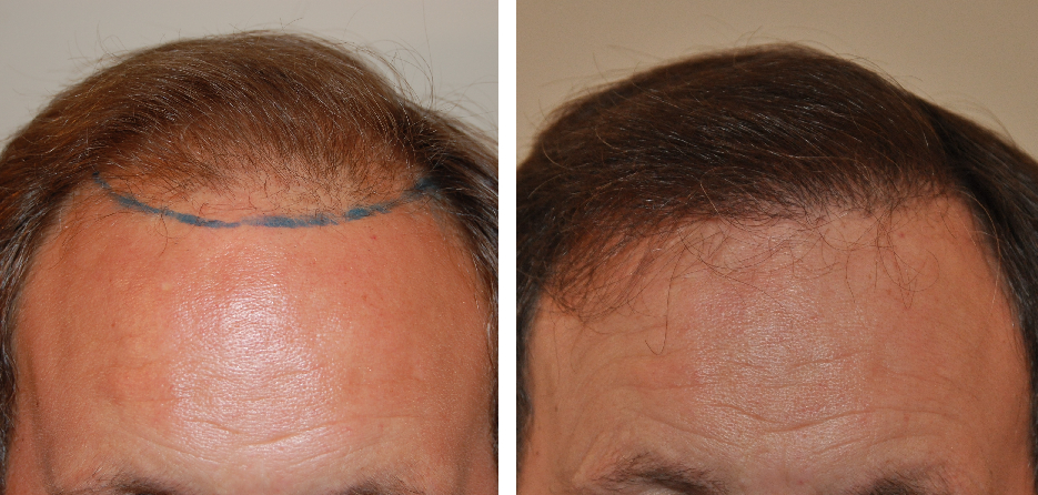 Hair Transplant Hawaii - Sometimes a small amount of grafts is all that is  needed. Only 1000 grafts were used to achieve this hairline and the patient  is perfectly happy! 👍 #hairtransplant #