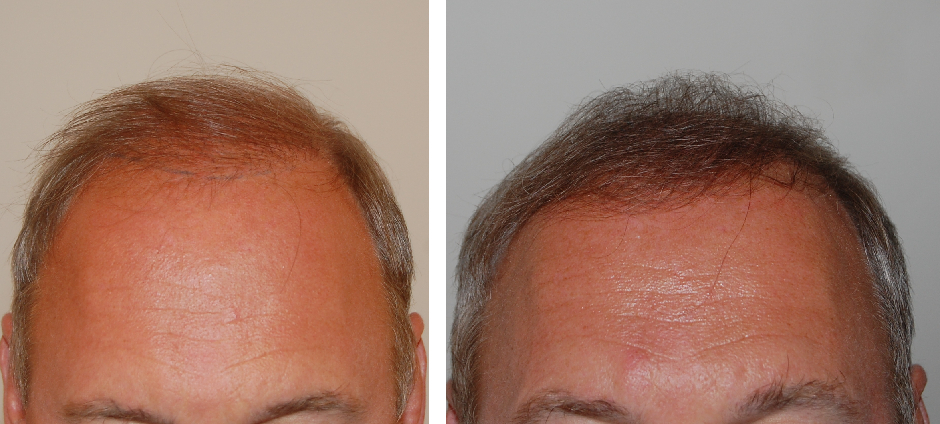 before and after 1000 graft FUE hair transplant